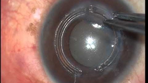 Turnaround technique for overcoming false channels during Intacs implantation Soosan Jacob