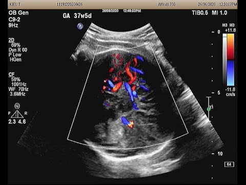 Video Fetus 38 weeks, D-TGA, ACC, chuyển vị đại động mạch... - youtube