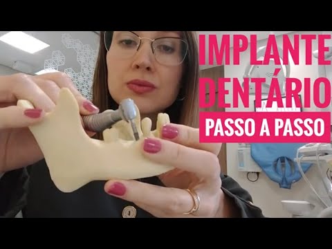 Vídeo: Implante Endosteal: Tipos E Procedimentos Para Implantes Dentários