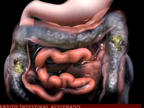 Dolor pélvico por síndrome de intestino irritable