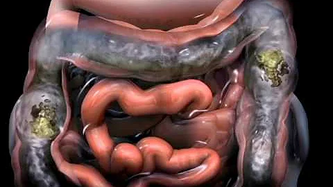 ¿Pueden los intestinos provocar presión pélvica?