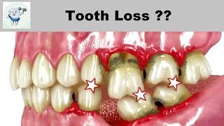 Consequences of Tooth Loss