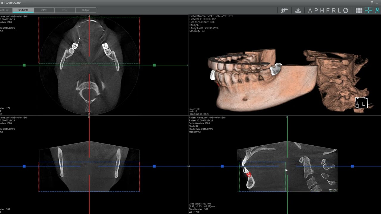 Adding Implant Crowns with the X-era Dental Cone Beam From ImageWorks