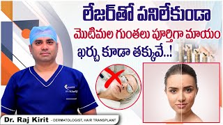 మొటిమల గుంతలు పూర్తిగా మాయం | How to Treat Acne Scars Without Laser? | Celestee Skin And Hair Clinic