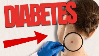 10 UNEXPECTED Signs Of Diabetes On The Skin!