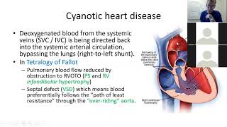 Weekly Paediatric Lecture 2021 21 Cardiac disease in children II July 19