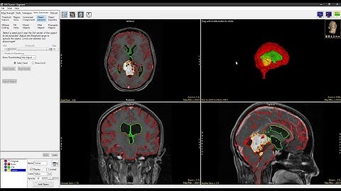 Analyze 15.0 - Segment: Multiple MR Object Segmentation using Object Extractor
