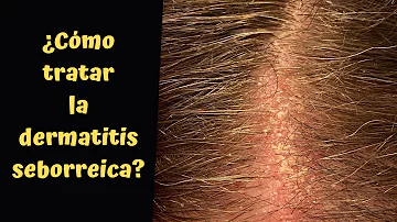 ¿Afecta el azúcar a la dermatitis seborreica?