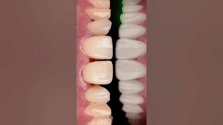 Digital Smile Design with Veneers!  #shorts #dentaltech #veneers