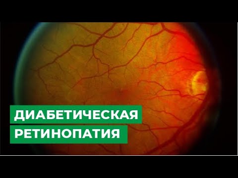 Видео: Как лечить диабетическую ретинопатию: 8 шагов (с иллюстрациями)