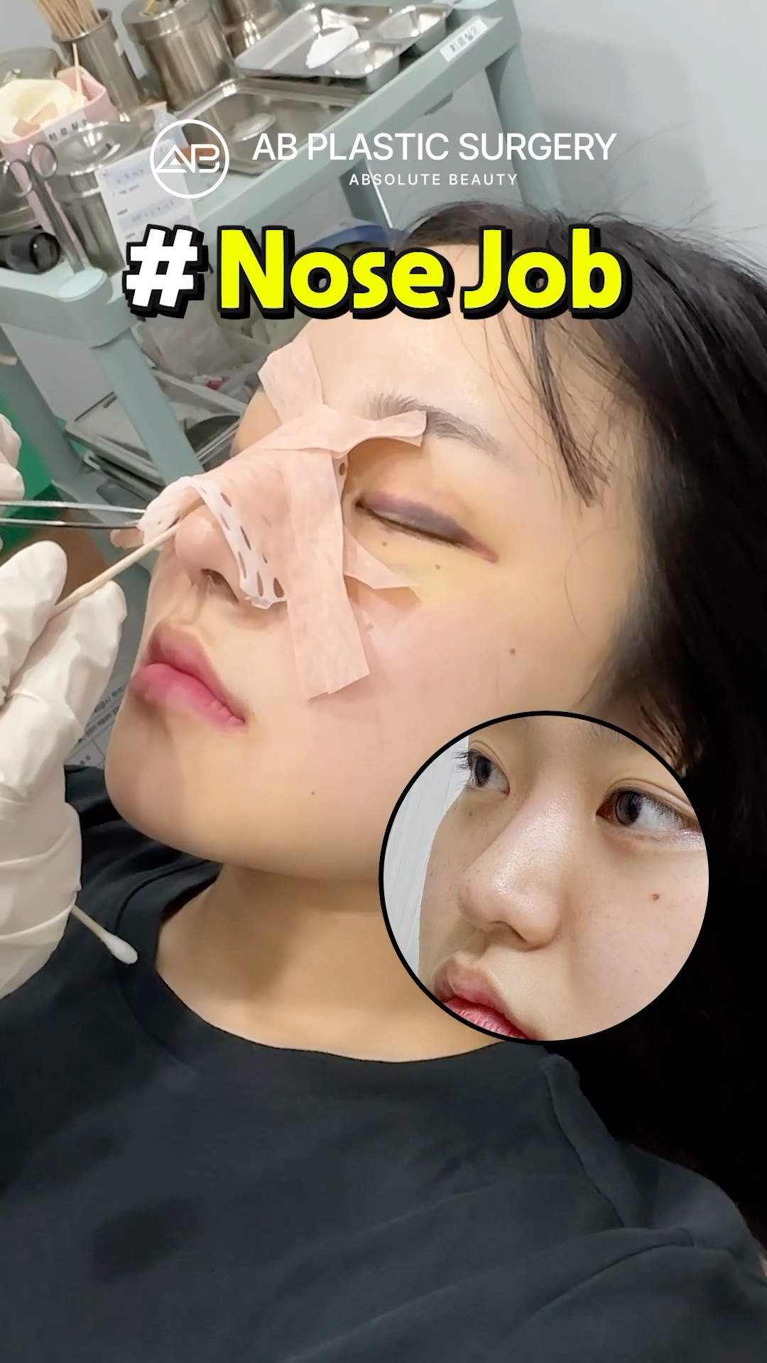 Watch Her Nose Cast Removal – Shocking Transformation #shorts