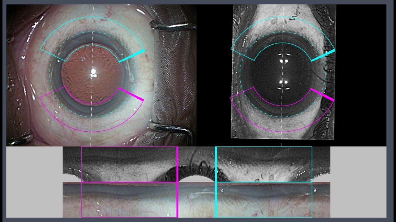PureSee Toric Lens Implantation - YouTube