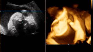 2.1 胎児超音波診断について | 産婦人科・小児科三井病院