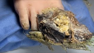 ASMR Toenails Cutting