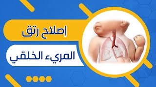 Thoracoscopic - جراحة انفصال خلقي بالمرئ وناصور بالقصبة الهوائية - د. خالد صلاح