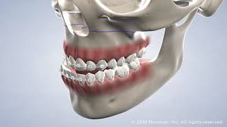 Adult Orthodontics at Warren Orthodontics, Springville, UT