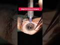 Live Cataract Surgery Procedure I Steps-By-Steps Cataract Surgery