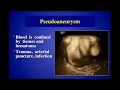 Pseudoaneurysms: Diagnosis and Treatment