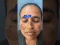 One Cream For Pigmentation And Melasma Shorts Ytshorts Skincare Pigmentation Melasma Cream