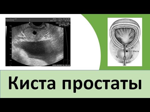 Киста простаты