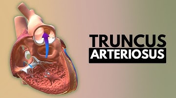 Truncus Arteriosus, Causes, Signs and Symptoms, DIagnosis and Treatment.