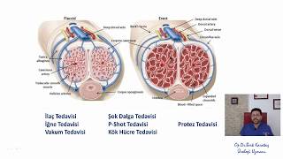 E Şok Dalga Tedavisi Nasıl Etki Eder ?