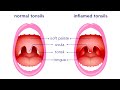 Effective Ways To Remove Tonsil Stones Without Surgery!