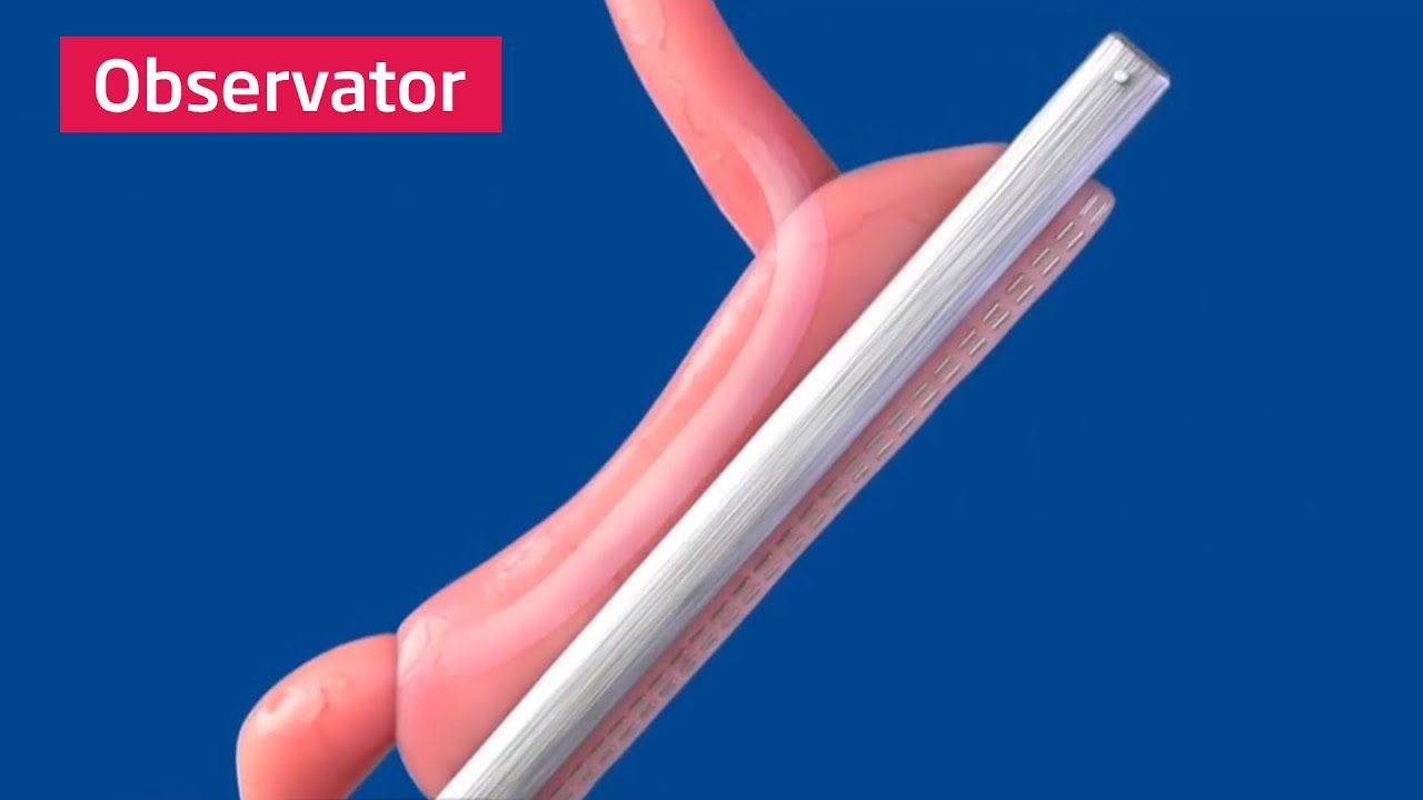 Totul despre operația de micșorare a stomacului. Ce presupune intervenţia „Gastric Sleeve”