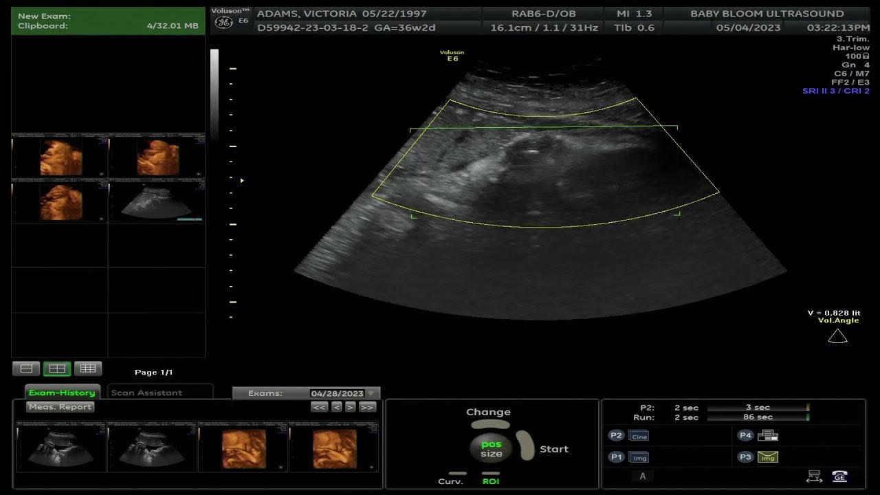Baby bloom ultrasound live stream youtube