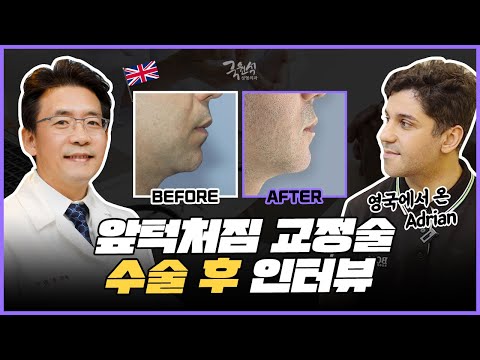 영국에서온 adrian, 앞턱처짐 교정 수술 후 솔직한 인터뷰! 이미지