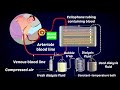 How a dialysis machine works  dialysis  artificial kidneys