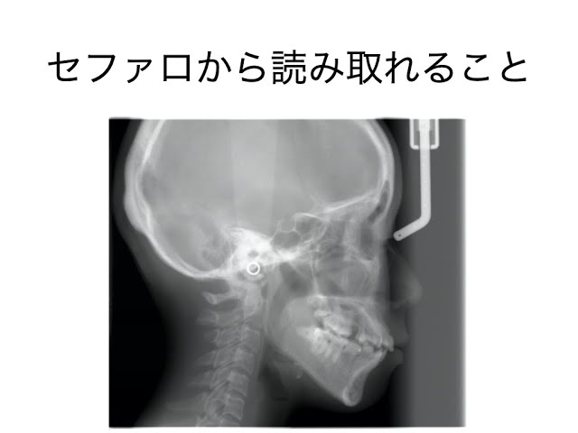 セファロ分析 カンタン解説 - YouTube