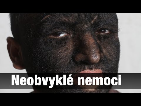 Video: Teethingův Syndrom: Přehled, Symptomy A úleva Od Bolesti