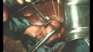 Еюногастропластика рака желудка - eyunogastroplastika gastric cancer Еюногастропластика рака желудка - eyunogastroplastika gastric cancer