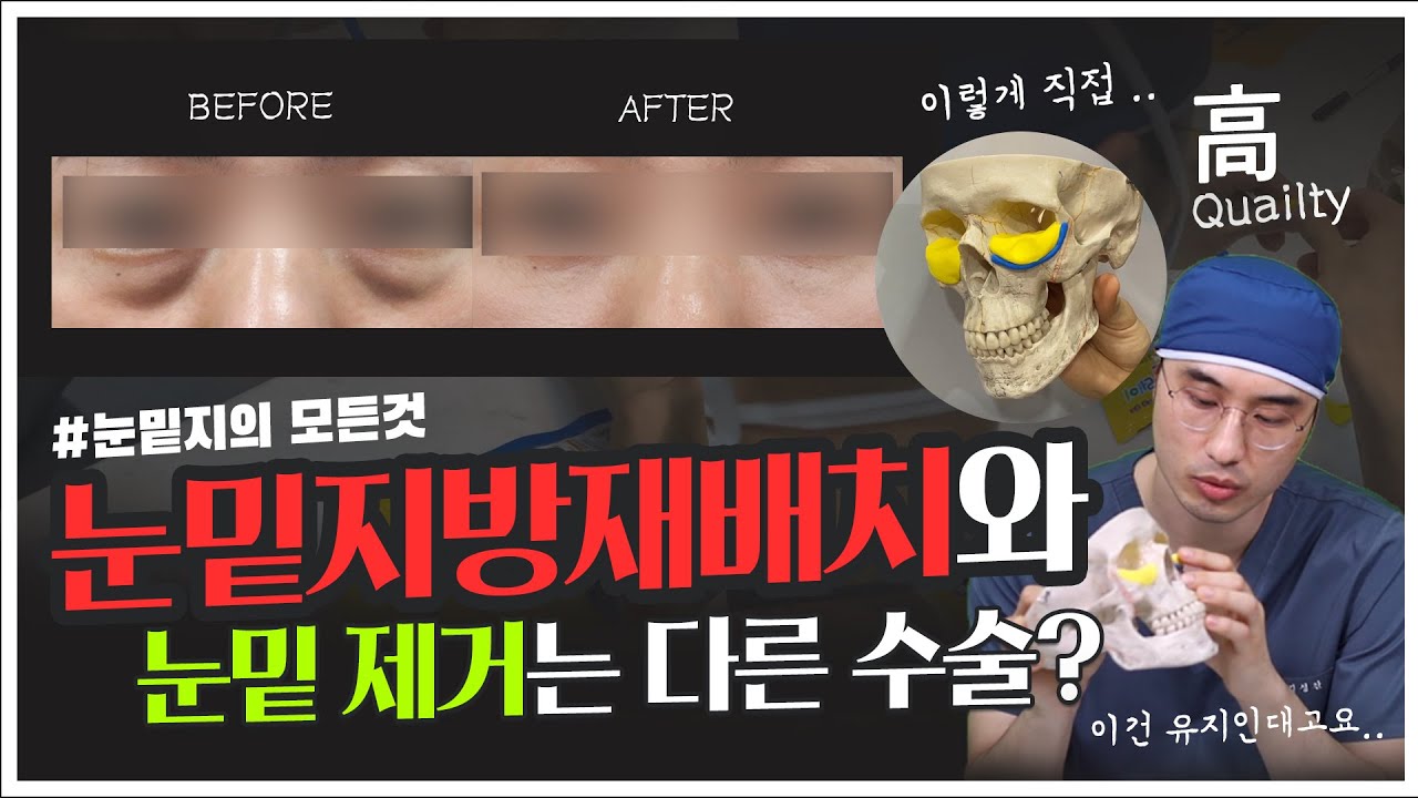 눈밑지방재배치 이런 경우에는 하지마세요! 직접 자가진단으로 해보는 눈밑지 TEST