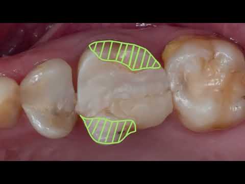 مين قال إن كل ضرس بيتعمله عصب لازم يتغطى بطربوش ويتبرد كله Uptowndental Drahmedmotawie دأحمد مطاوع 