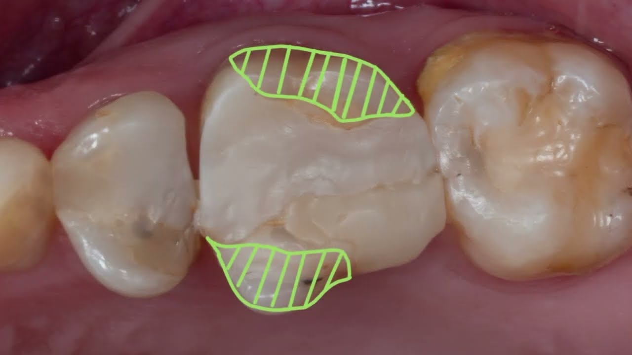 مين قال إن كل ضرس بيتعمله عصب لازم يتغطى بطربوش ويتبرد كله؟
