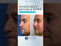 Male Rhinoplasty 8 Months Later 👃💯 | Dr. Daniel Becker