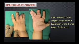 #Pinnacleorthocentre SYNDACTYLY IN BOTH HANDS : DR. PARAG LAD