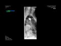 Hilzo esophageal atm stent