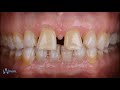 Case collection for diastema closure with composite resin 9 nine cases