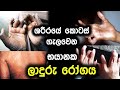 ශරීරයේ කොටස් ගැලවෙන භයානක ලාදුරු රෝගය | Ladhuru | Leprosy Sri lanka | Leprosy Causes in World 2024