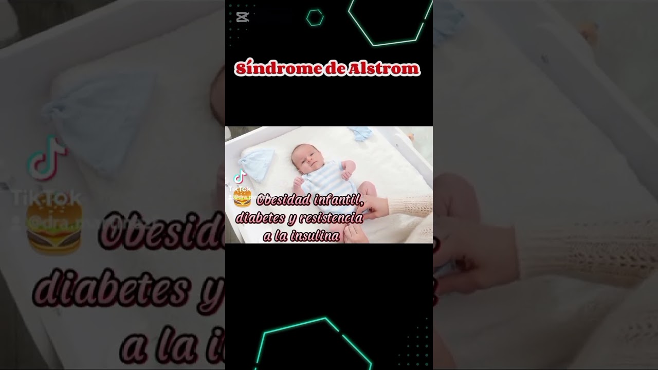 síndrome de Alström