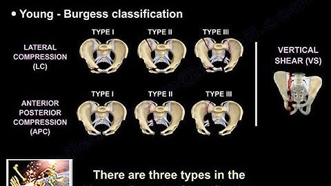 Pelvic Fractures - Everything You Need To Know - Dr. Nabil Ebraheim