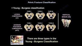 Pelvic Fractures - Everything You Need To Know - Dr. Nabil Ebraheim