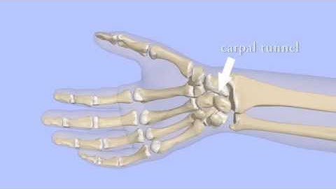 Carpal Tunnel Syndrome