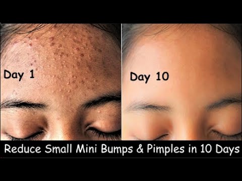 Get rid of heat Bumps on Face|Damaged Skin Repair|Close Open Pores&Pimples in 10Days|Clear Skin