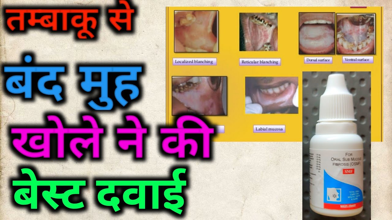 तम्बाकू,गुटखा  से बंद मुह खोलने की बेस्ट दवाई।। SMF GEL ||  मुह खोले || oral sub mucus fibrosis