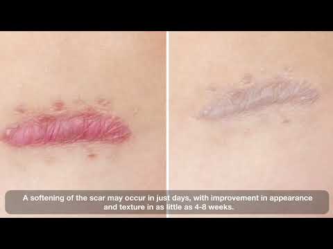 WOUND FREE Silicone Scar Dressing by AD Surgical thumbnail