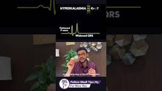 High potassium in body ECG changes in Hyperkalemia